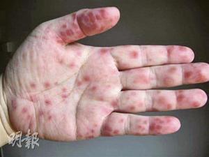 香港一女护士染肠病毒亡 双手出疹照上班(图)