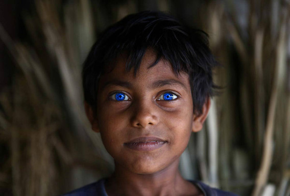 孟加拉男孩长有如同异鬼一样蓝色瞳孔