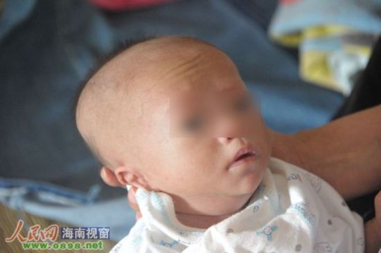 琼海男婴被误诊为先天性梅毒 治疗致头发脱落